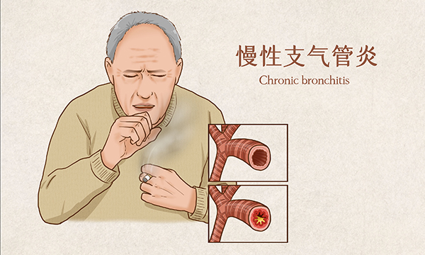 慢性支气管炎重在预防 及时治疗很关键